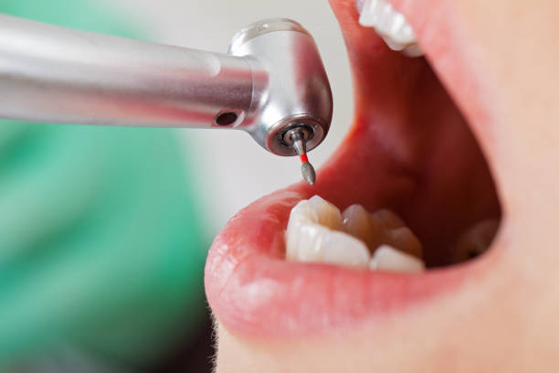 Best Emergency Tooth Extraction in Cisco, TX